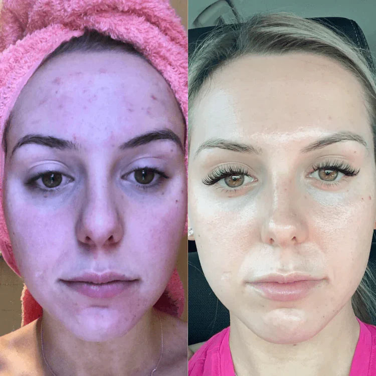 EMS Microcurrent Face Lifting Device