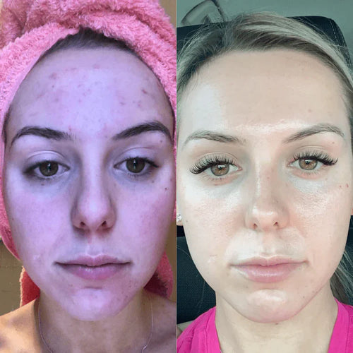 EMS Microcurrent Face Lifting Device